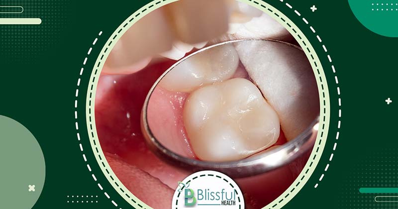Tooth decay brown stain on Teeth: Cause & sign & Prevention 