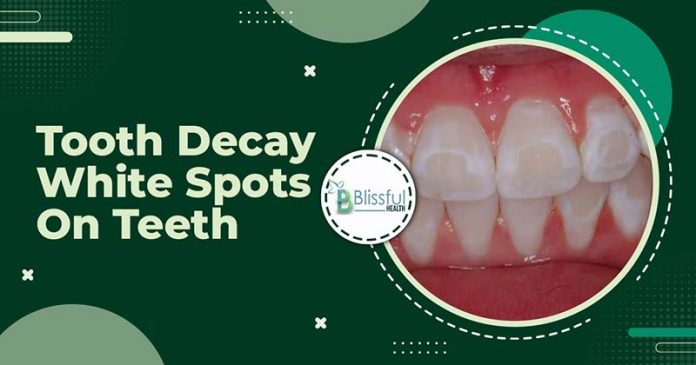 Tooth Decay White Spots On Teeth: Causes and Prevention