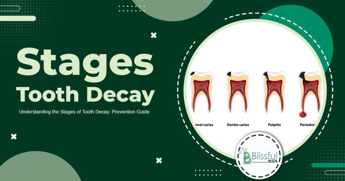Stages Of Tooth Decay: Discover And Prevent Tooth Decay For A Healthy Smile