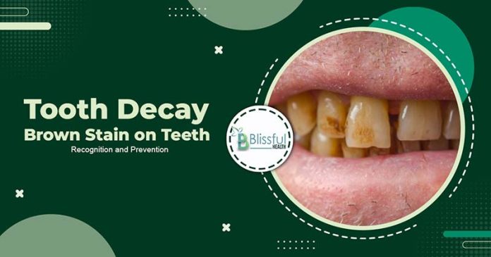 Tooth decay brown stain on Teeth: Cause & sign & Prevention