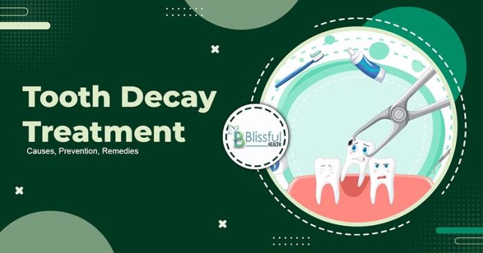 Tooth Decay Treatment: Causes, Prevention, Remedies