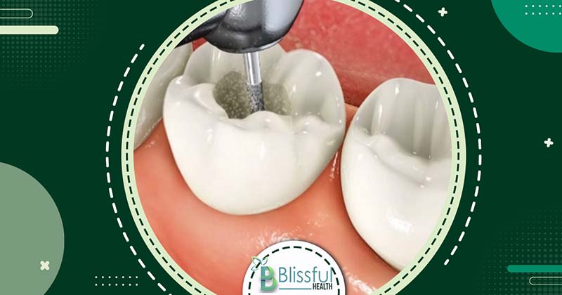 How to prevent Tooth Decay Under Crown: Signs, Prevention, and Treatment