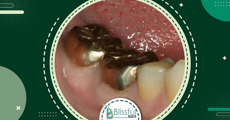 How to prevent Tooth Decay Under Crown: Signs, Prevention, and Treatment