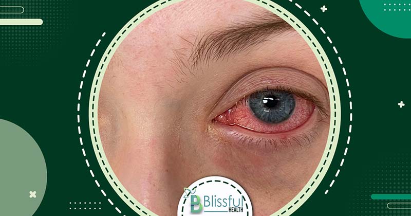 The Disease Is Often Misdiagnosed as Pink Eye?