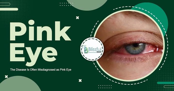 The Disease Is Often Misdiagnosed as Pink Eye?