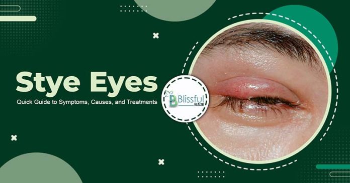 Stye Eyes: Quick Guide to Symptoms, Causes, and Treatments