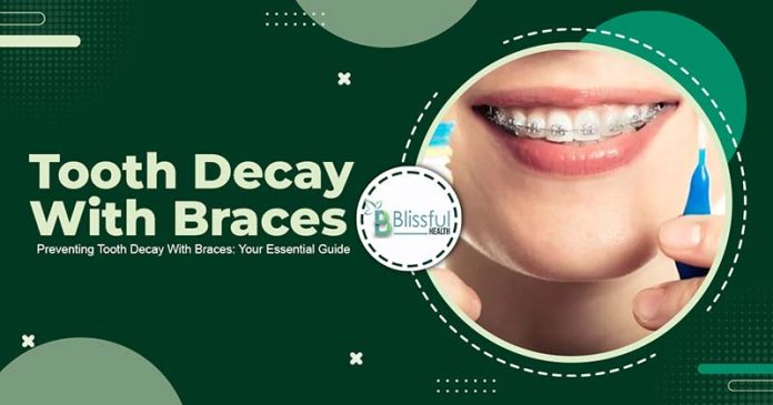 Preventing Tooth Decay With Braces: Your Essential Guide
