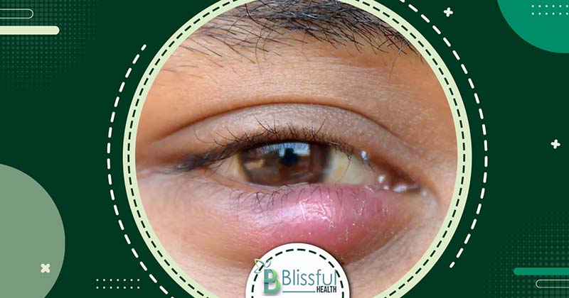 Common cases of Eye Infections